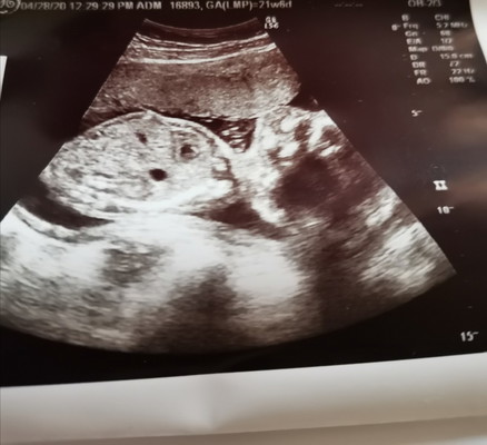 Ultrasound