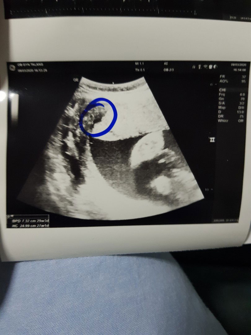 ลูกกลับหัวแล้ว