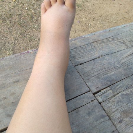 เท้าบวมมากท้อง8เดือนทำไงถึงทูเลาลงบ้างค่ะ