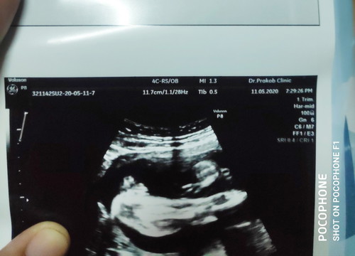 24w. คุณแม่ว่าผญหรือผช