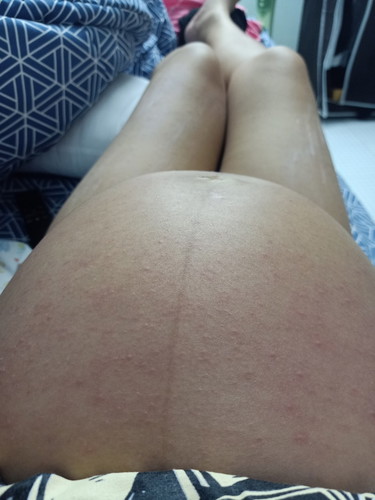 มีใครแพ้ผื่นแบบนี้บ้างค่ะ