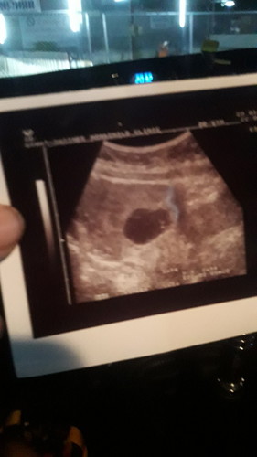 แท้งมา 2ครั้ง ติด