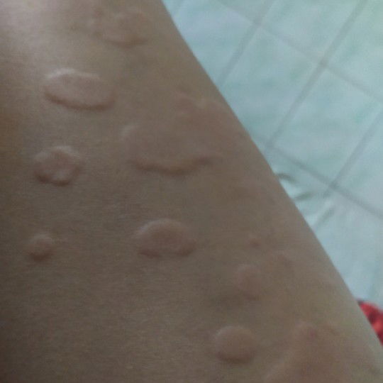 Gatal Gatal saat Hamil Muda