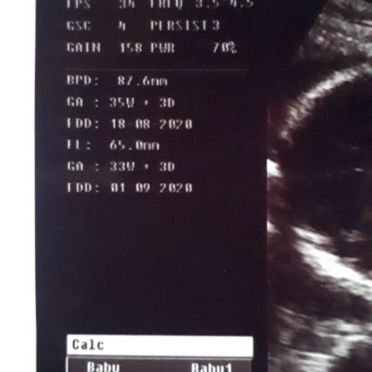 berat n besar janin 33 week menuju 34 week