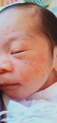 baby acne