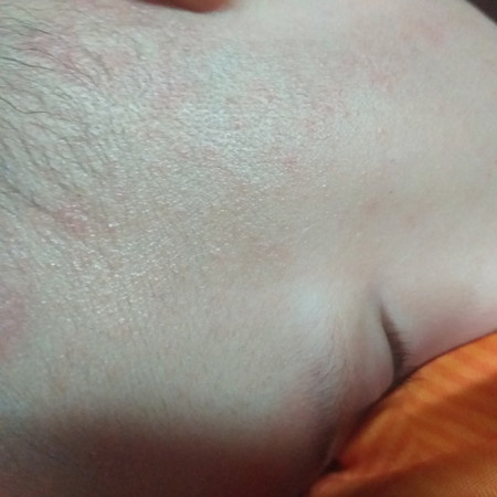ลูกเป็นผื่นคันแบบนี้ใช้ยาอะไรดีค่ะ
