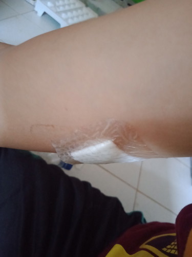 ผ้าก๊อตปิดแผลฝังยาคุมหลุด