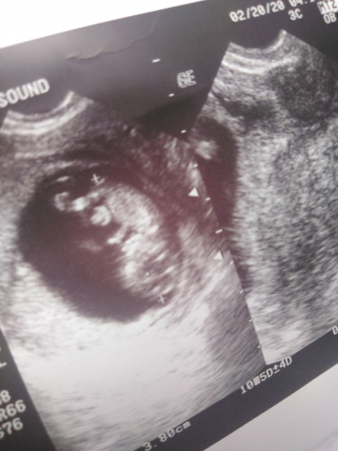 Retrochorionic Hemorrage