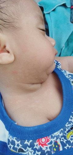 puti putisa balat ni baby drake