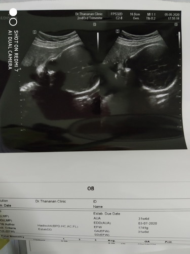 ท้องได้29+2ค่ะทำไมดูในภาพเหมือหัวเด็กดูโต