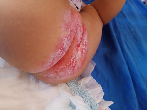 Rashes