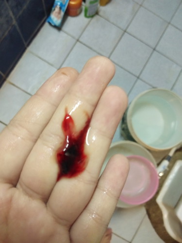 หลังจากตรวจปากมดลูกเเล้วเปิด2.5เซน
