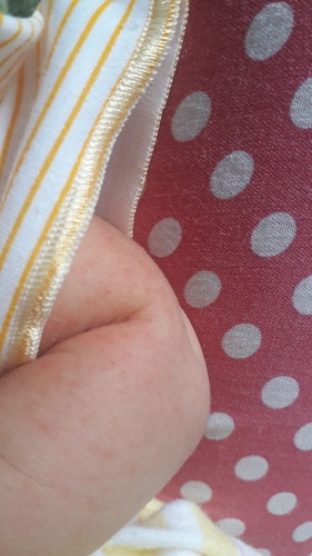 merah bintik pada bayi