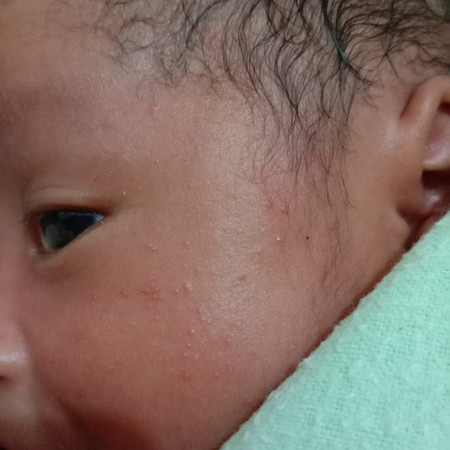 bintik2 merah area muka bayi