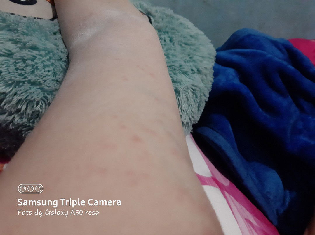 gatal" di seluruh badan