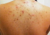 Back acne normal in pregnancy?