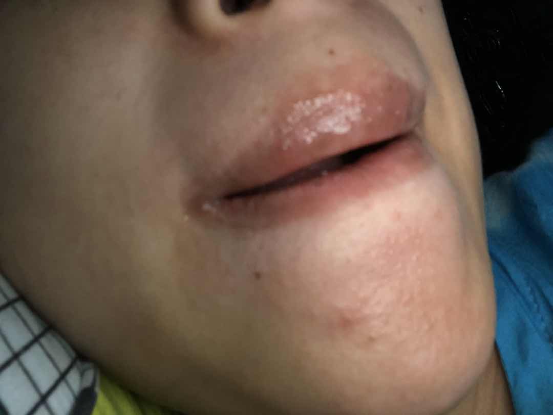 Beruntusan hormon kah?