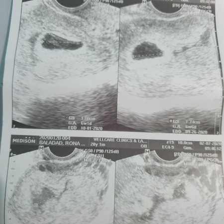 Anembryonic Pregnancy / blighted ovum