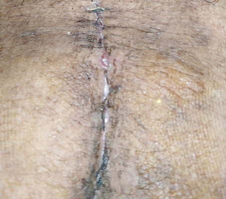 CS INCISION