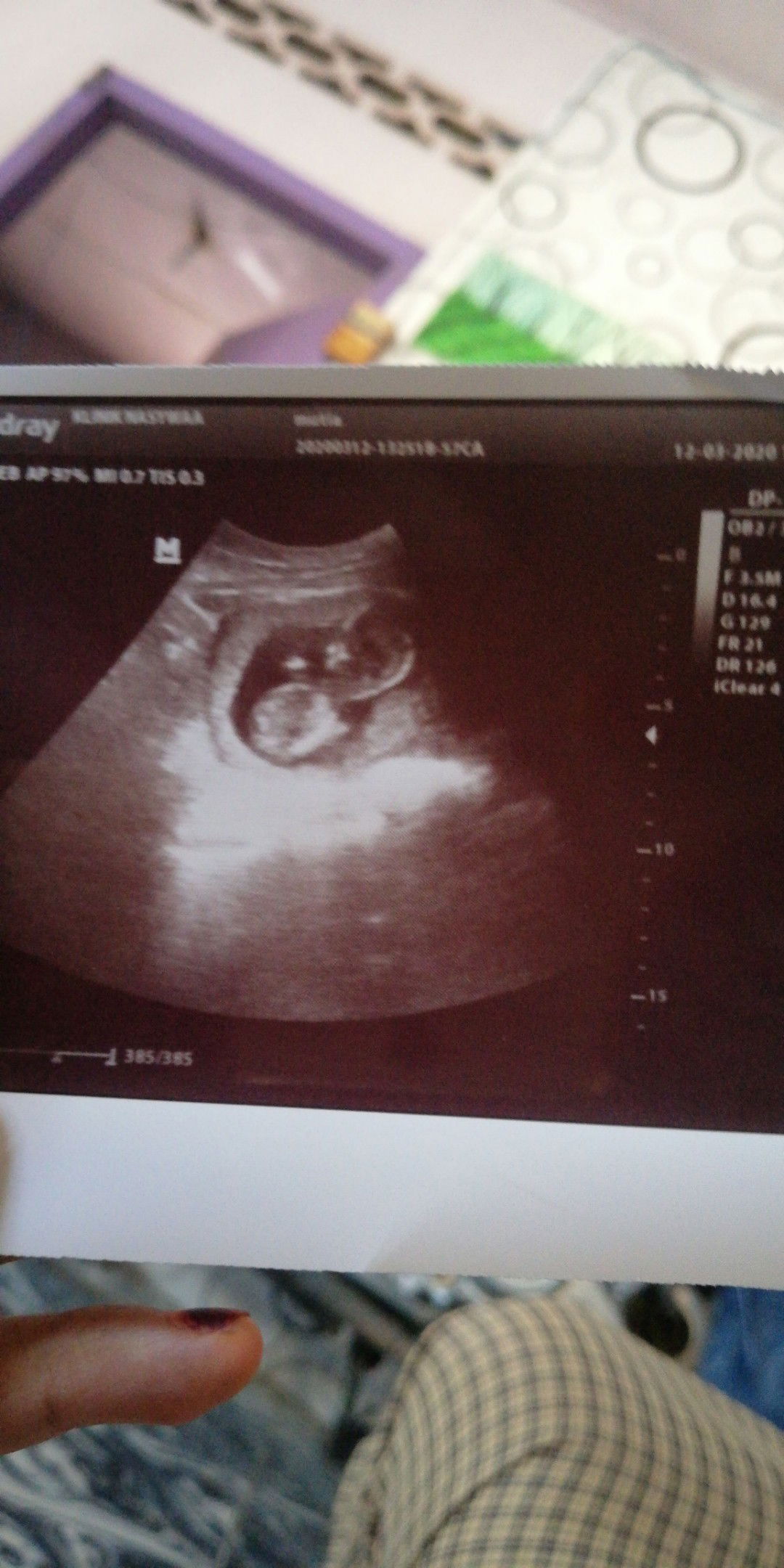 arti singkatan Pada hasil usg