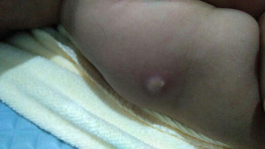 Bekas imunisasi BCG1