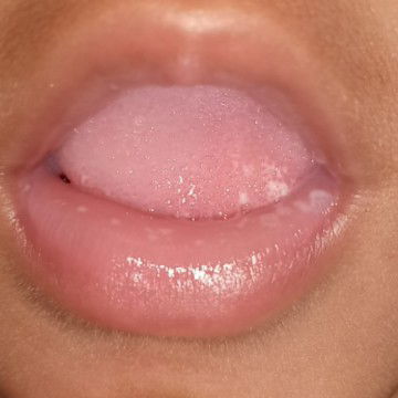 putih di lidah dan bibir