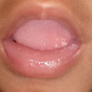 putih di lidah dan bibir