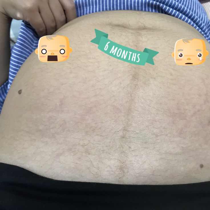 27 week 4 day ท้องเริ่มมีรอยแดง เริ่มแตก ท้องแรกค่ะ