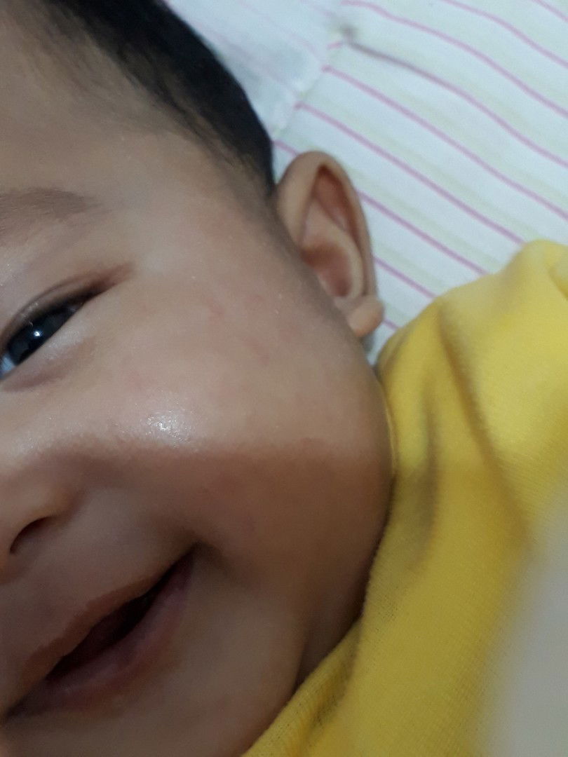 gatal gatal pada wajah