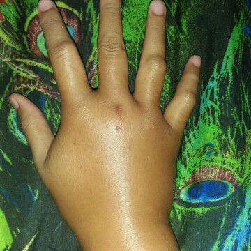 Tangan bengkak sebelah