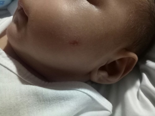 rashes