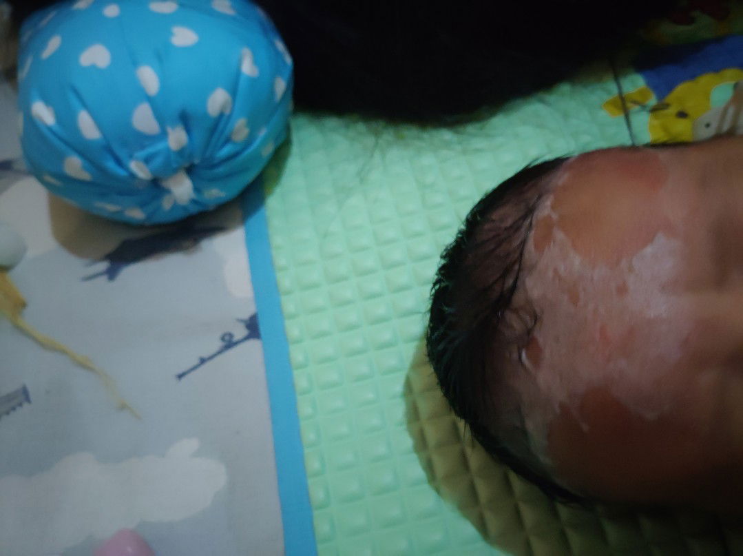 Kulit kepala bayi seperti berkerak