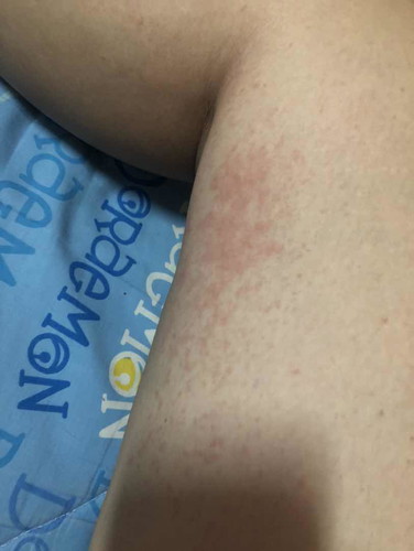 ผื่นที่ขา