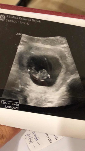 Detak jantung bayi tidak terdeteksi pertanda apa?