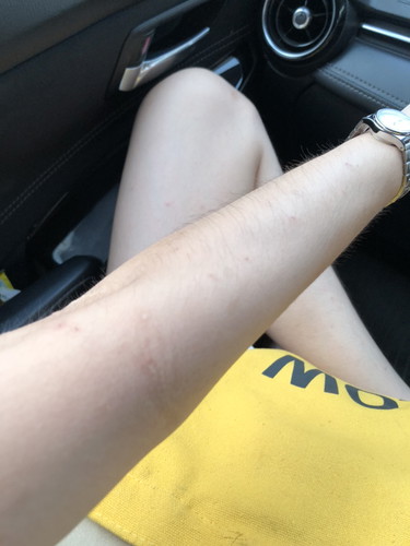 คันขนาดนี้..มีแม่ท้องคนไหนใช้อะไรกันบ้างคะ