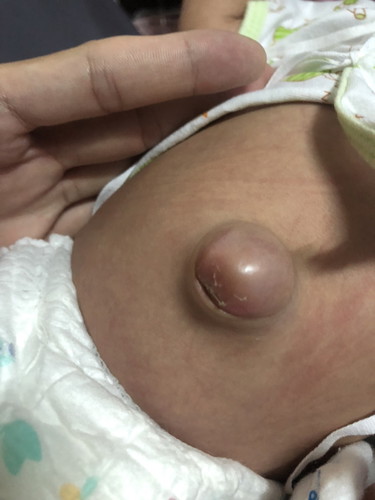 สะดือลูกผิดปกติ..?