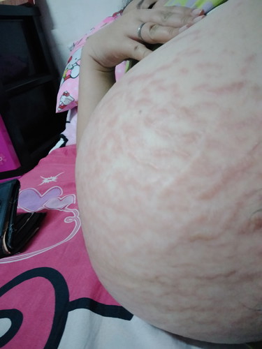 Stretch marks