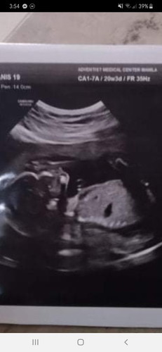 Ultrasound