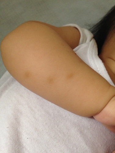 Insect bites