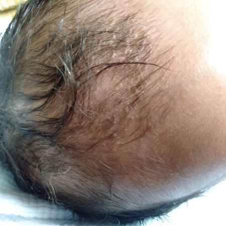 Parang dandruff?