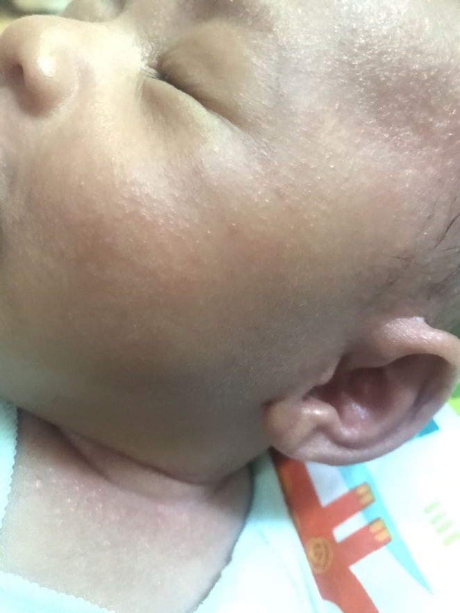 Biang Keringat pada bayi usia 1 bulan