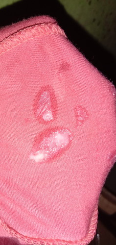 bunda maf jorok ,,bunda tolong. info ya dong ko kya gnih keputihan atau apa sih,,,soal kmren wktu tgl 2 udh kluar lendir coklat pagi,siang ya kluar lendir campur darah tpi dede ya masih ateng aj@