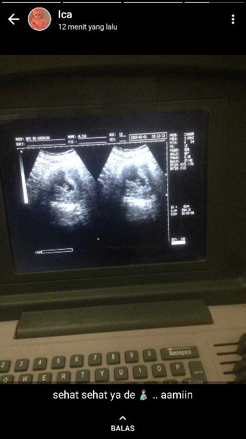 khawatir dengan perkembangan janin ku