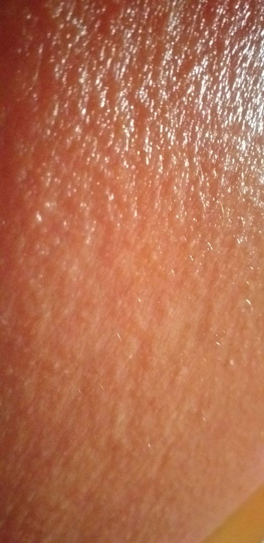 gatal  dibagian perut