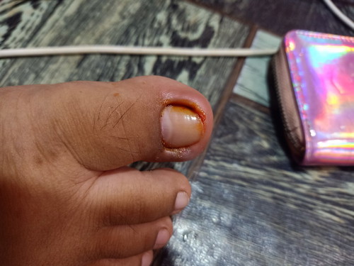 namamagang kuko sa paa