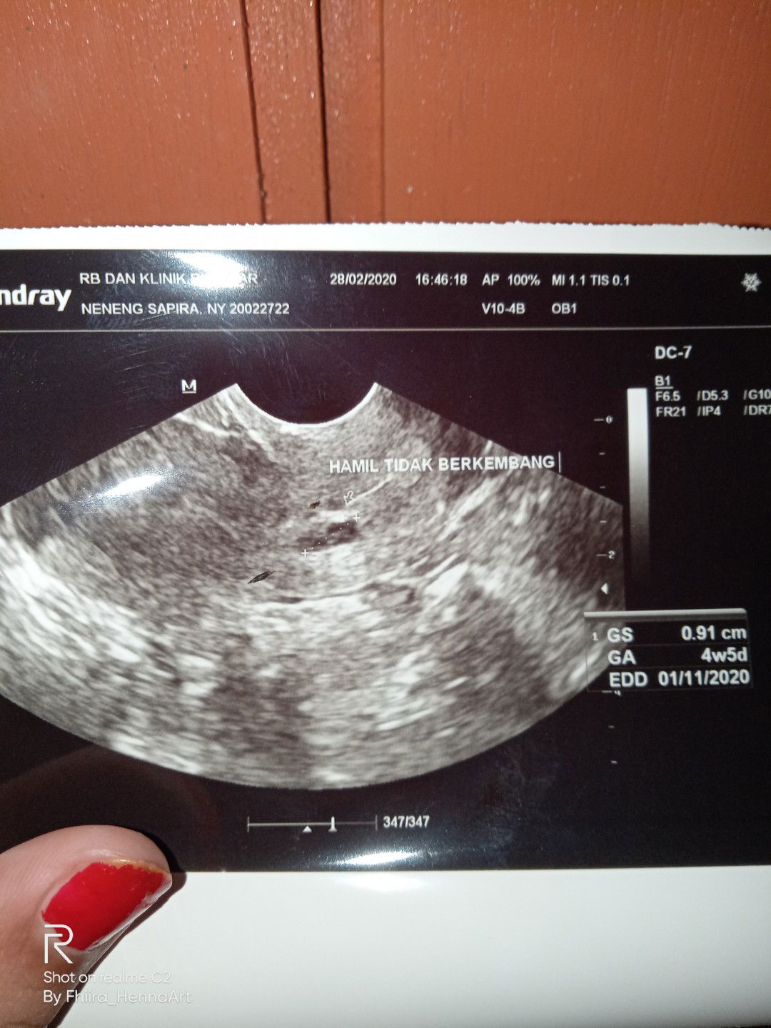 janin tidak berkembang??