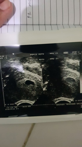 USG Kantung Kehamilan