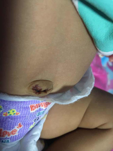 สะดือ มีเลือดซิบ