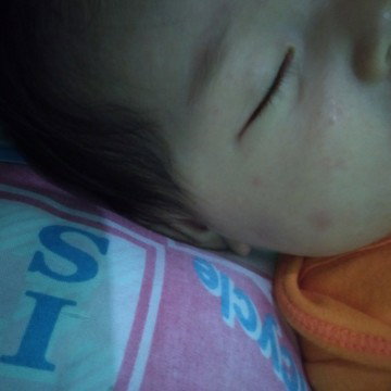 bị nổi mẩn đỏ , ngứa