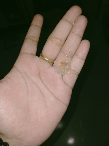 #38w3d มีมูกแบบนี้ควรไปหาหมอไหม